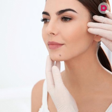 Как самостоятельно избавиться от папиллом