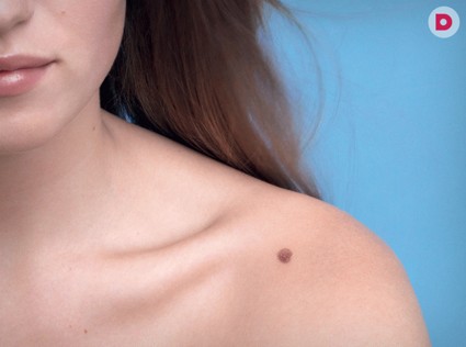 День диагностики меланомы