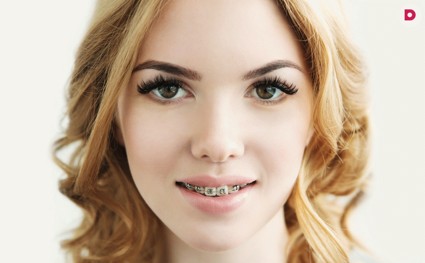 О пользе и применении брекетов